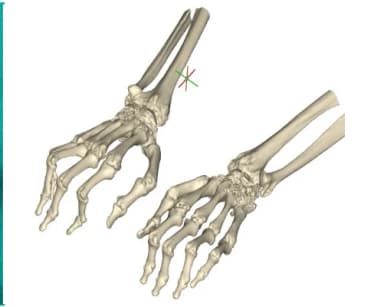 Proximal Interphalangeal Joint Arthroplasty