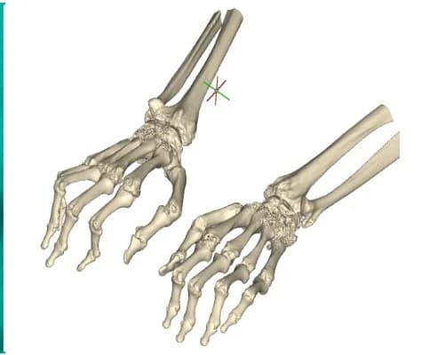 Proximal Interphalangeal Joint Arthroplasty