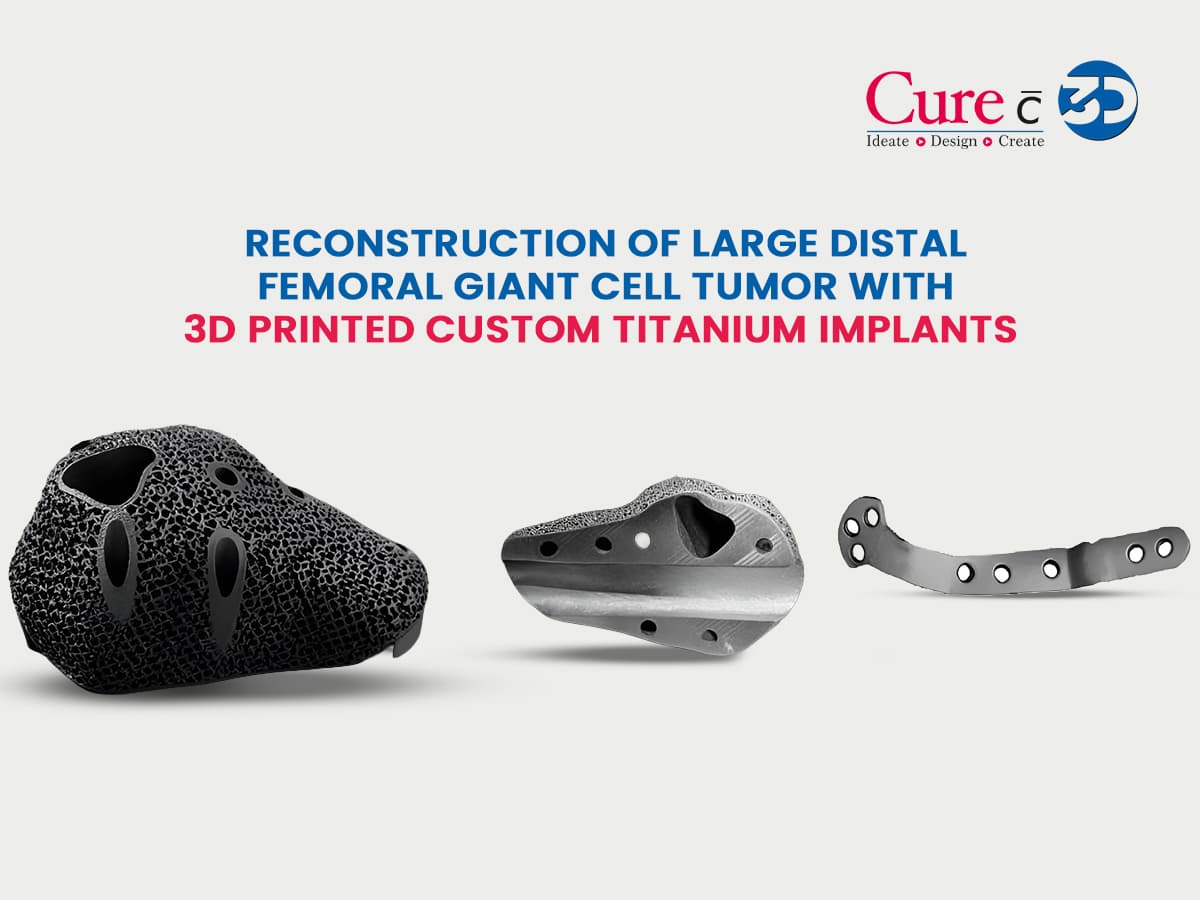 Reconstruction of Large Distal Femoral Giant Cell Tumor with a 3D Printed Custom Titanium Implant 