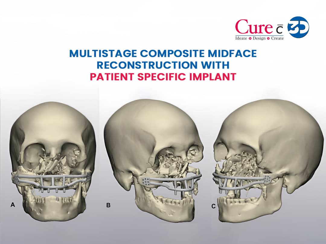 Multistage Composite Midface Reconstruction with Patient Specific Implant 