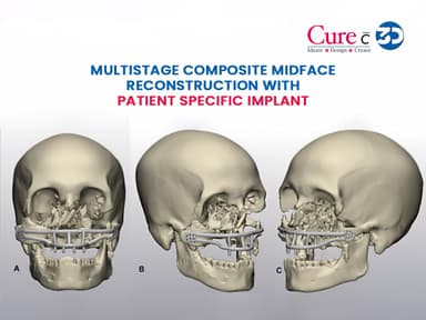 Multistage Composite Midface Reconstruction with Patient Specific Implant 