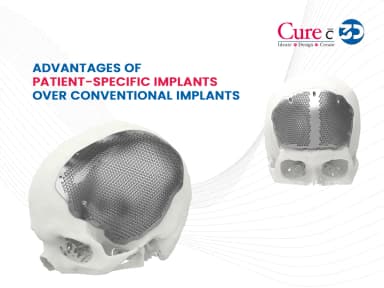 Advantages of Patient-Specific Implants over Conventional