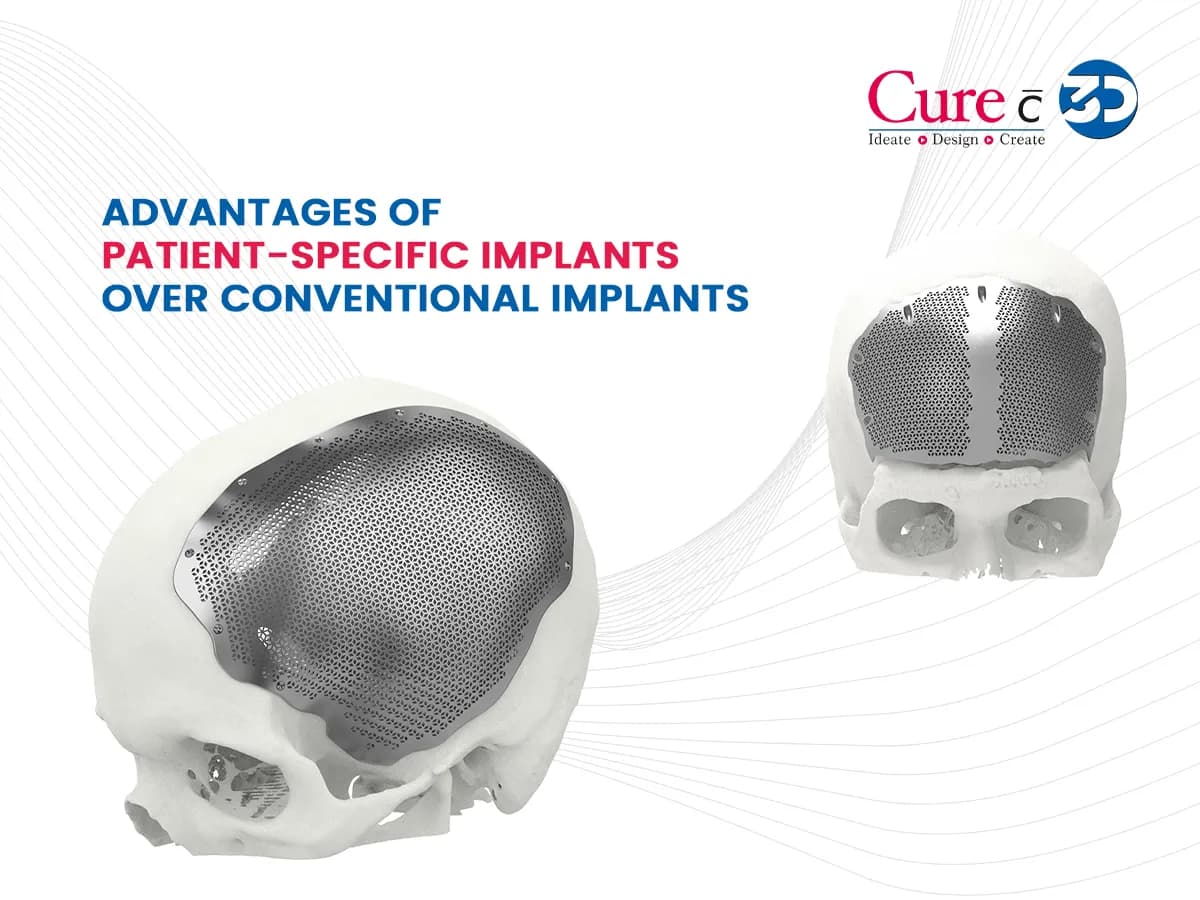 Advantages of Patient-Specific Implants over Conventional