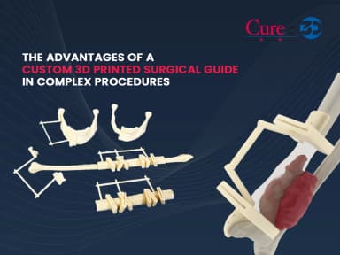 The Advantages of a Custom 3D Printed Surgical Guide in Complex Procedures