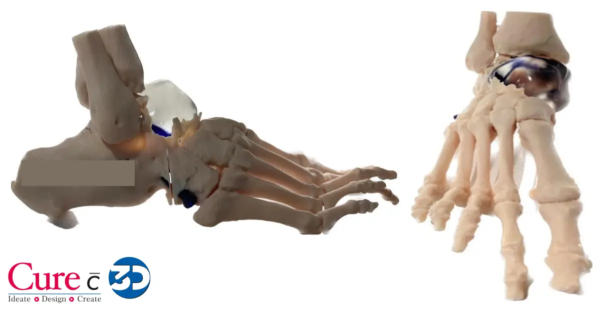 Perfect Fit: The Advantages of Customized 3D Printed Implants for Patients