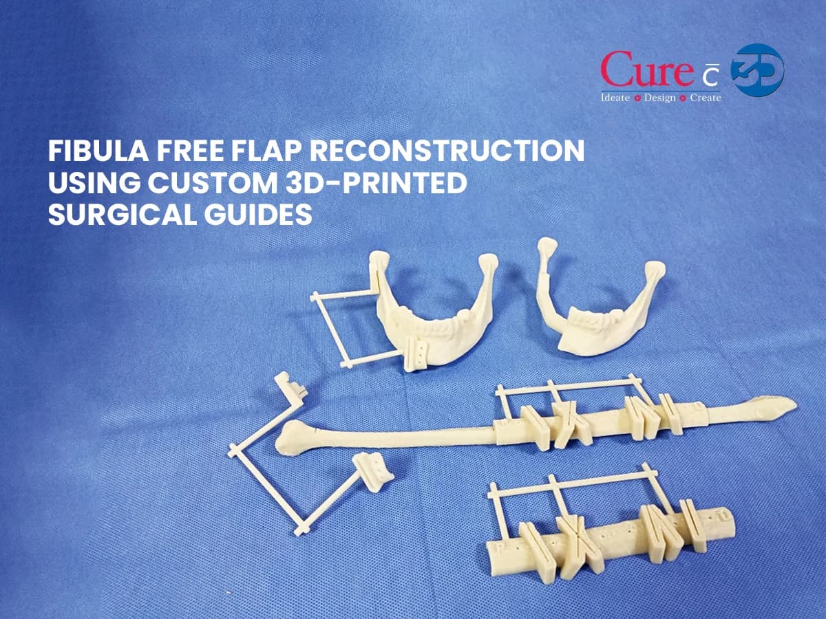 Fibula Free Flap Reconstruction Using Custom 3D-Printed Surgical Guides