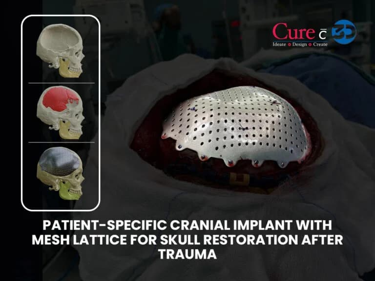 3D Printed Custom Titanium Cranial Implant for Cranial Reconstruction