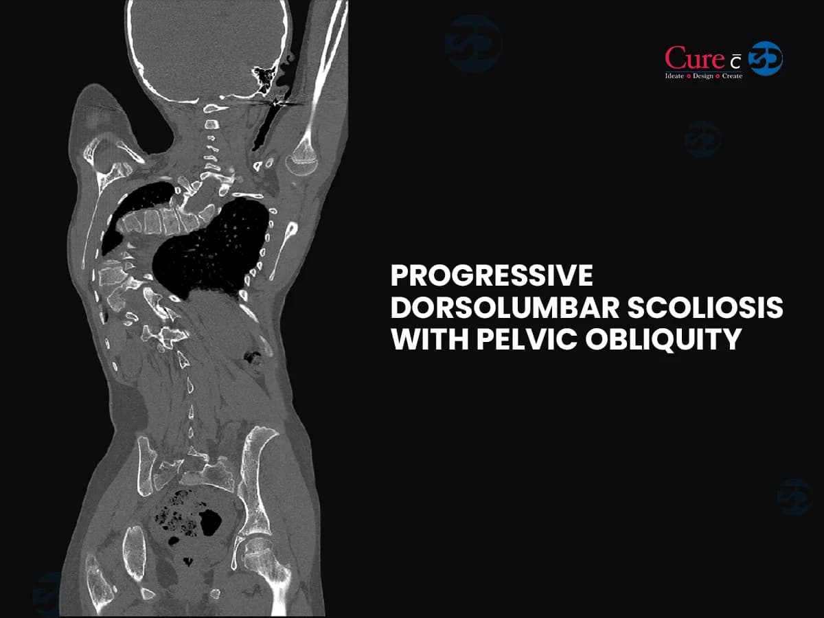 Progressive Dorsolumbar Scoliosis with Pelvic Obliquity
