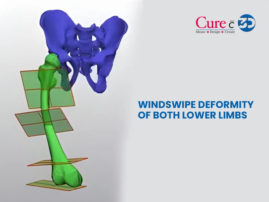 Windswipe Deformity of Both Lower Limbs
