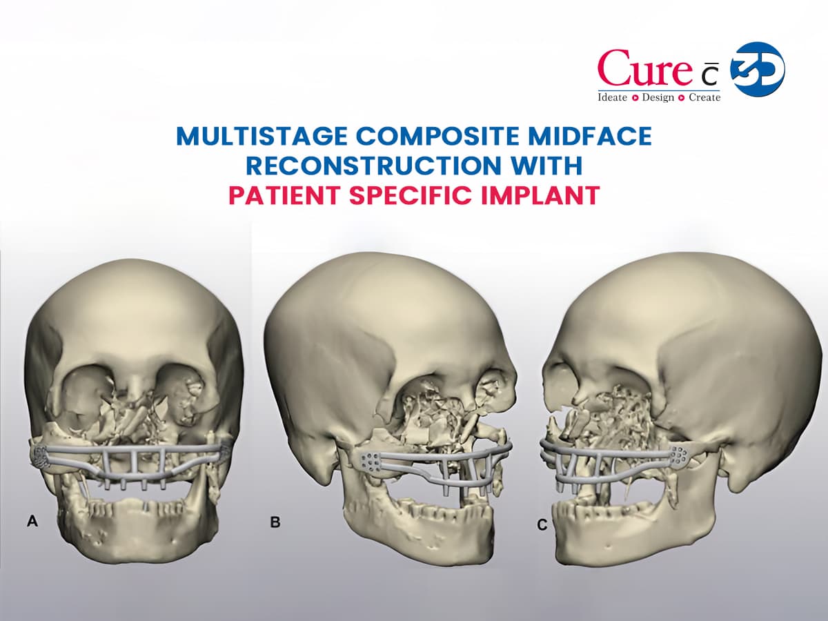 Multistage Composite Midface Reconstruction with Patient Specific Implant