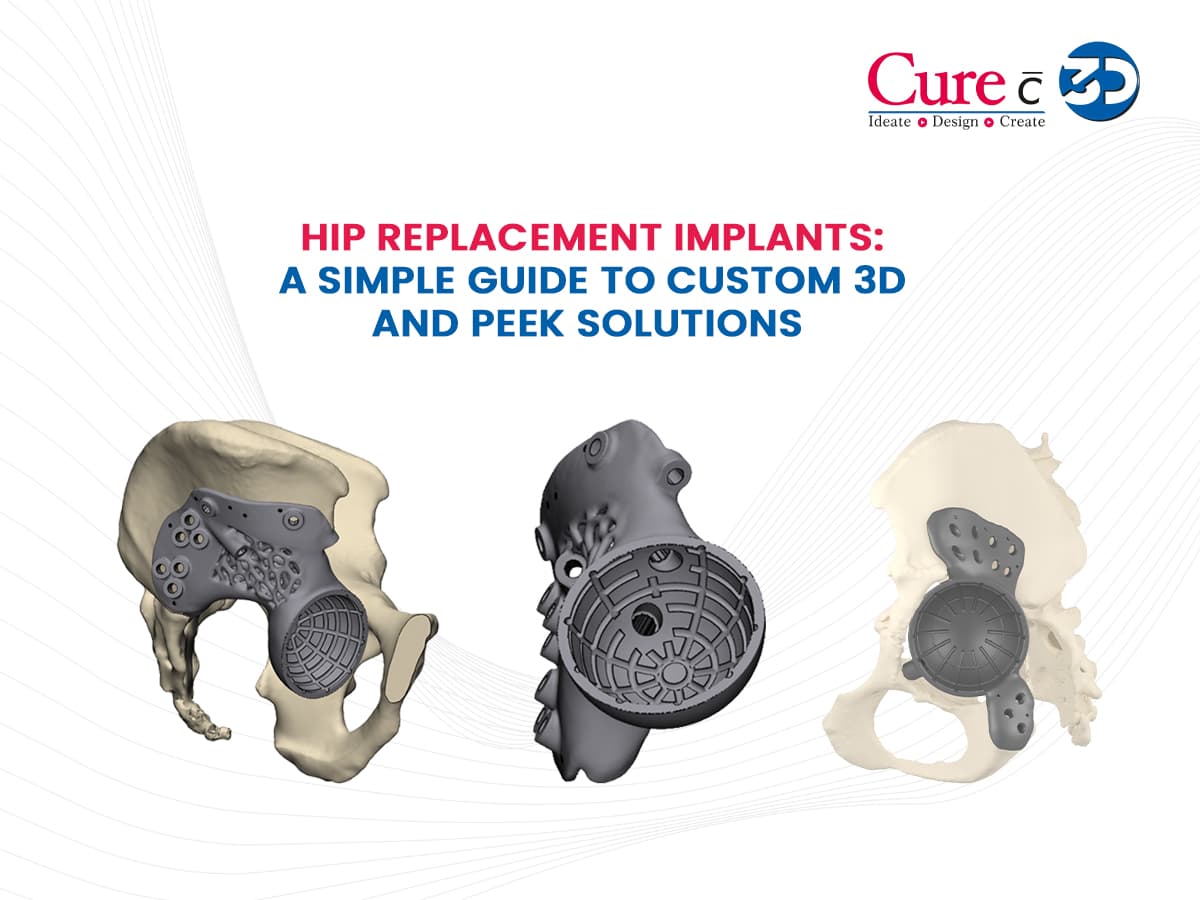 Hip Replacement Implants: A Simple Guide to Custom 3D and PEEK Solutions