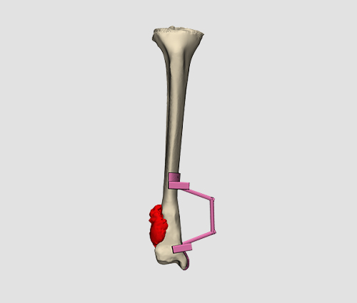 Virtual Surgery Planning (VSP)